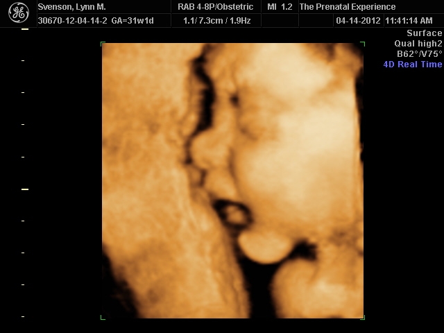 3D Ultrasound 1