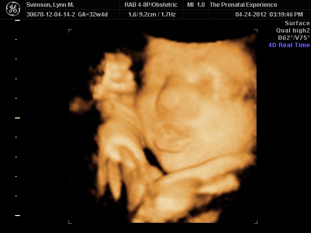 3D Ultrasound 11
