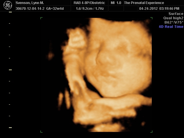 3D Ultrasound 12