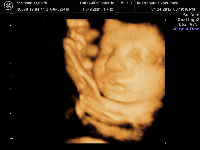 3D Ultrasound 13