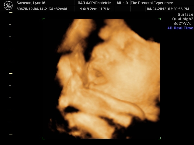 3D Ultrasound 15