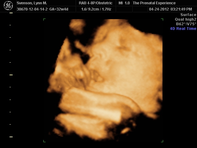 3D Ultrasound 16