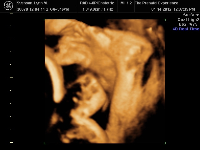 3D Ultrasound 6
