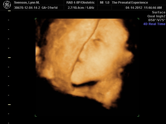 3D Ultrasound 7