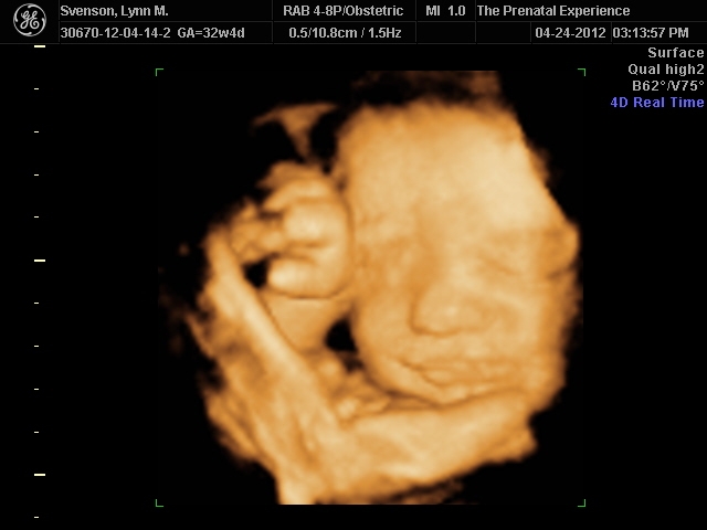 3D Ultrasound 9